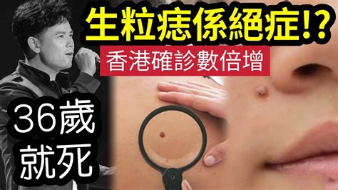 癦痣|【無瑕肌膚】癦與痣有何分別？脫癦又該如何選擇？